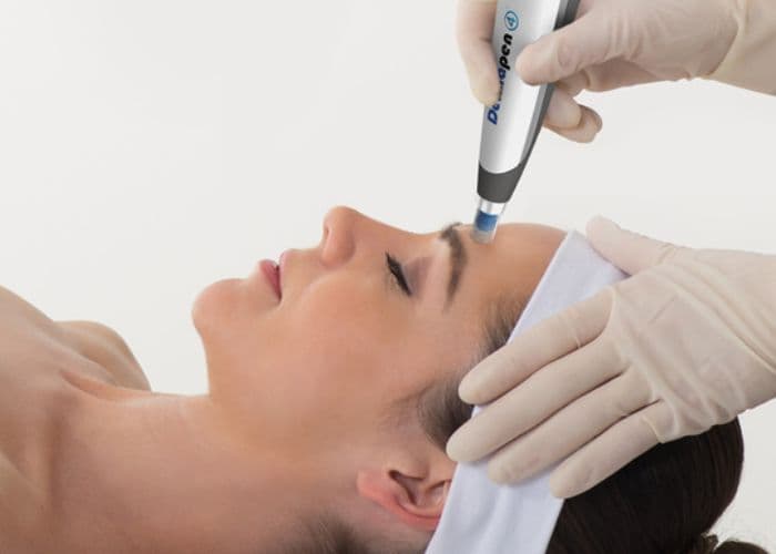 Microneedling collagen induction therapy for skin rejuvenation