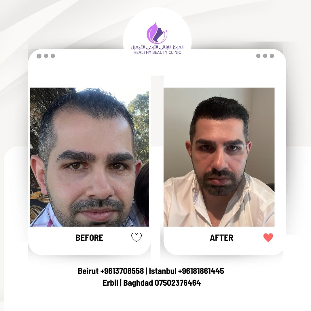 Hair Transplant in Jounieh and Keserwan: Your Kaslik Clinic Guide 2026