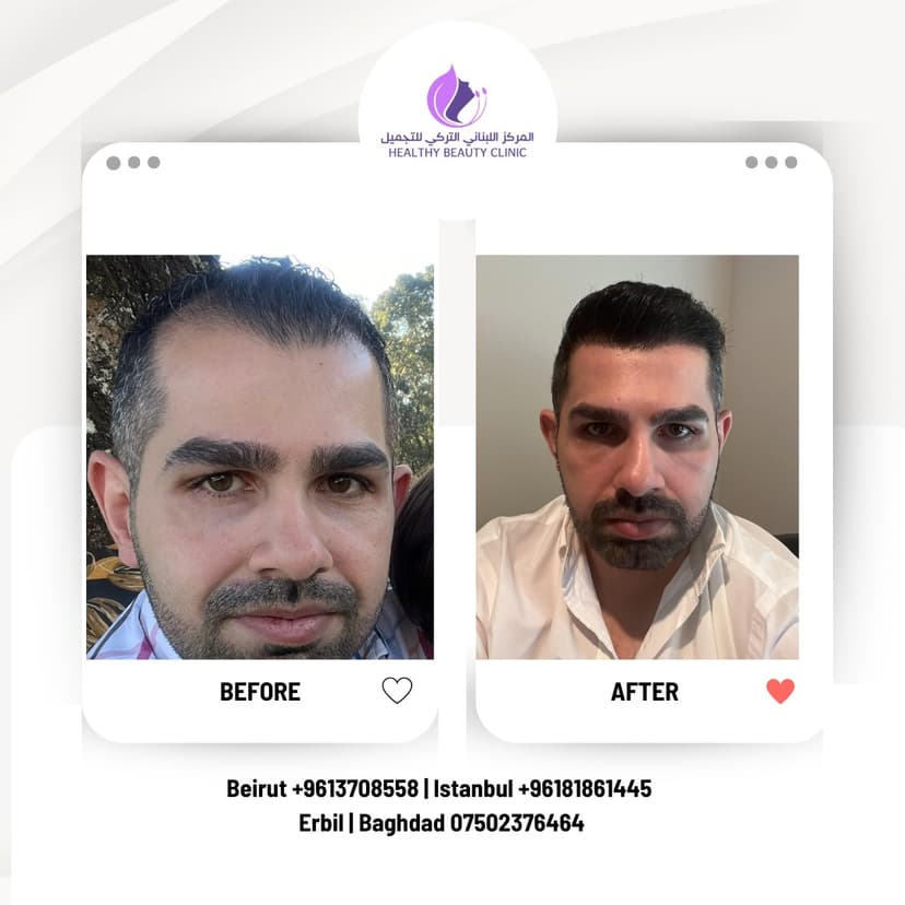 Hair Transplant in Jounieh and Keserwan: Your Kaslik Clinic Guide 2026