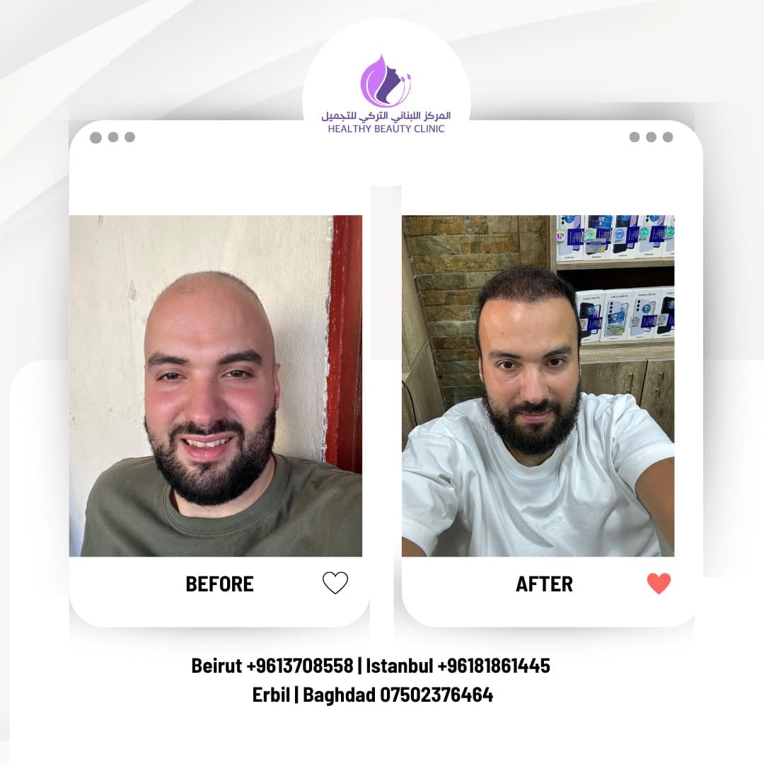 Crown Hair Transplant in Lebanon 2026: Grafts, Timing & Results