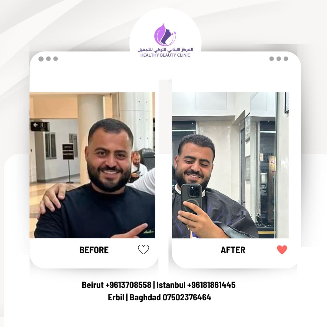 تساقط الشعر بعد الزراعة (الصدمة): لماذا يحدث ومتى يعود الشعر؟ 2026